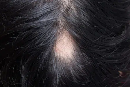 Alopecia Areata Day, il 29 novembre visite dermatologiche all’Aou Senese Alopecia areata