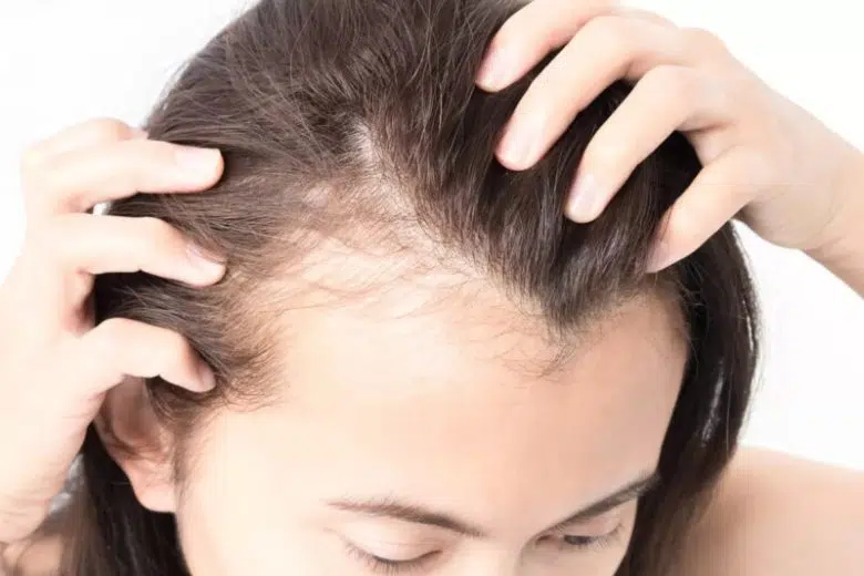 Donna con alopecia