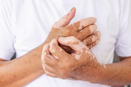 Vitiligine Week, consulenze gratuite all’Aou Senese Vitiligine sulle mani
