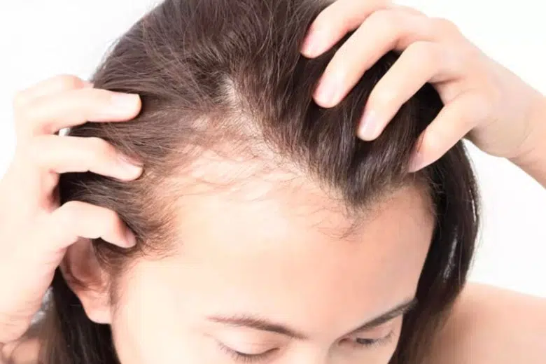 Alopecia Areata Day, il 19 dicembre visite dermatologiche all’Aou Senese Alopecia, donna